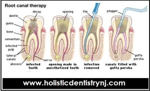 Holistic Dentist Root Canal Alternatives Treatment NJ/NYC - Dr. Philip Memoli